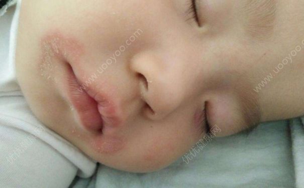 寶寶脫皮怎麼護理？寶寶脫皮的護理方法有哪些？(2)