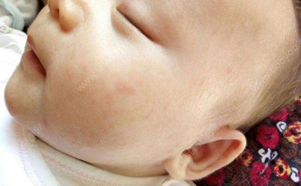 寶寶脫皮怎麼護理？寶寶脫皮的護理方法有哪些？(3)