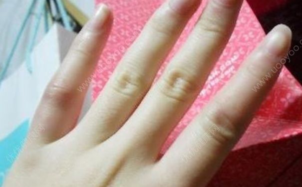 冬季皮膚怎麼預防凍瘡?冬季要怎麼避免被凍傷瞭?(2)