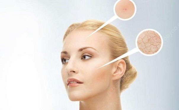 冬季皮膚幹燥該怎麼辦？冬季如何緩解皮膚幹燥？(3)