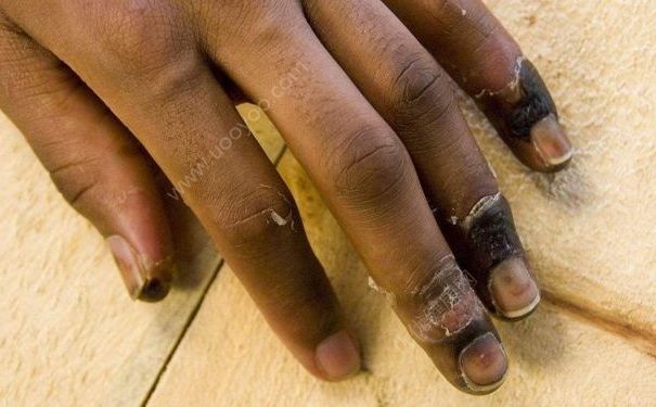 冬天為什麼會長凍瘡？冬天長凍瘡是何原因？(2)