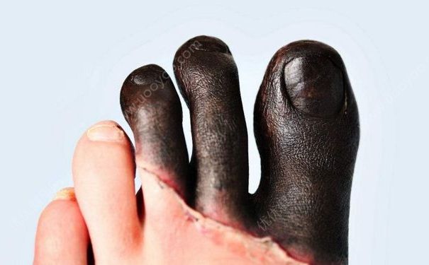 冬天為什麼會長凍瘡？冬天長凍瘡是何原因？(3)